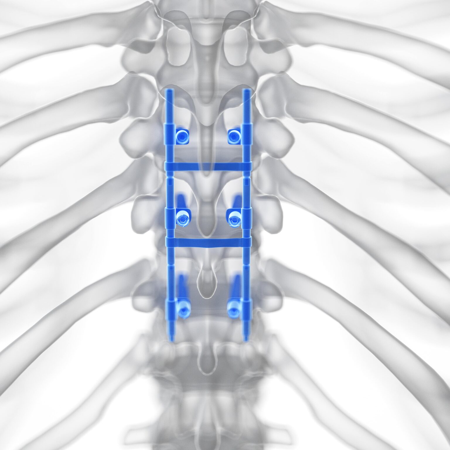 Pros And Cons Of Spinal Fusion Surgery New Jersey Comprehensive