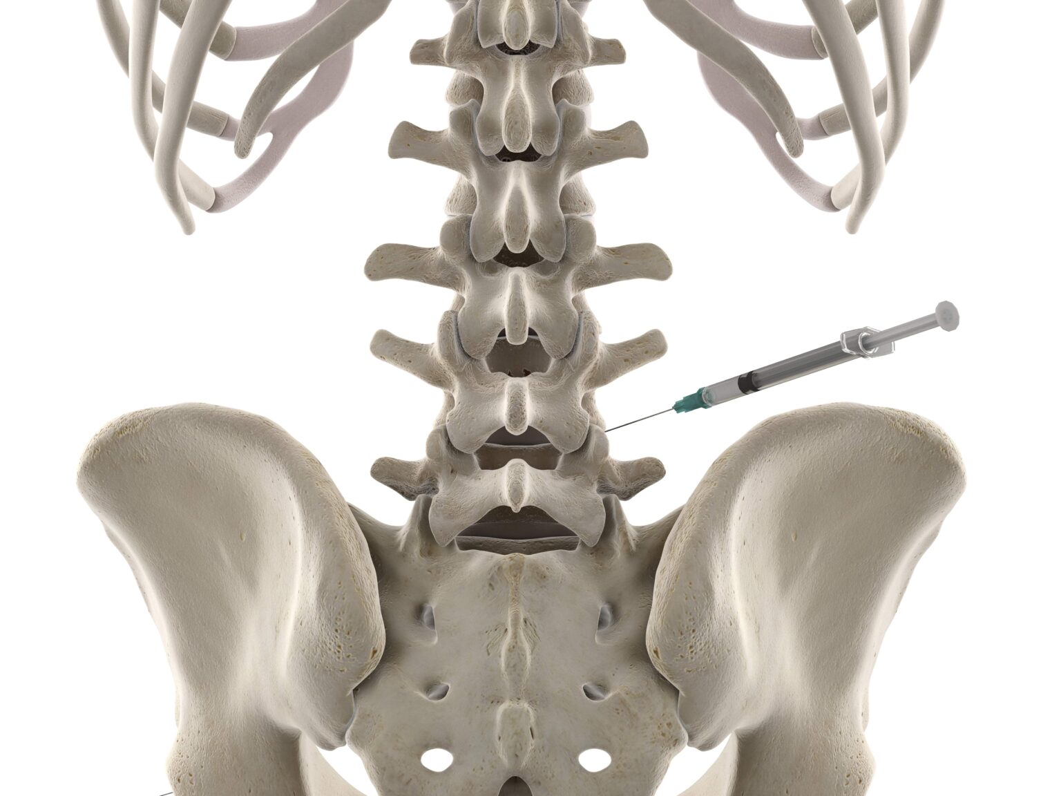 What Is An Intradiscal Injection New Jersey Comprehensive Spine Care