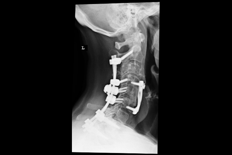 Cervical Laminectomy Posterior Cervical Fusion 