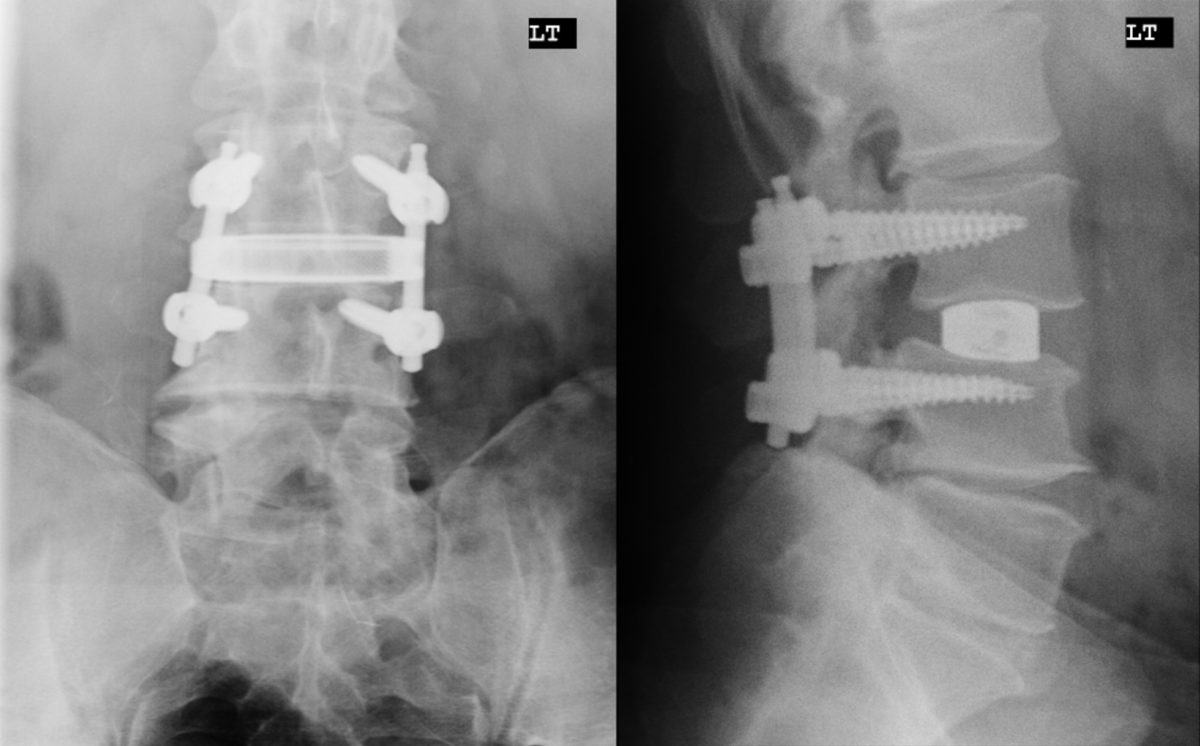 lateral-interbody-fusion-treatment-in-nj-comprehensive-spine-care