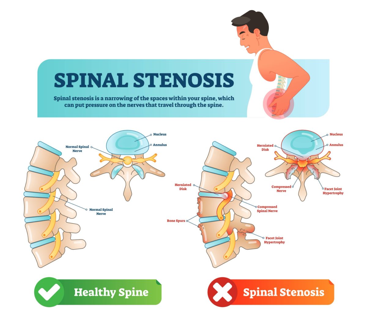 degenerative-lumbar-spinal-stenosis