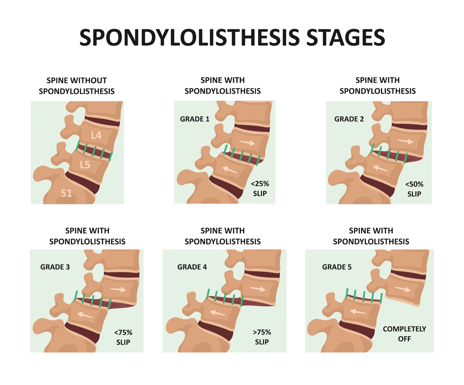 spondylolisthesis symptoms and signs