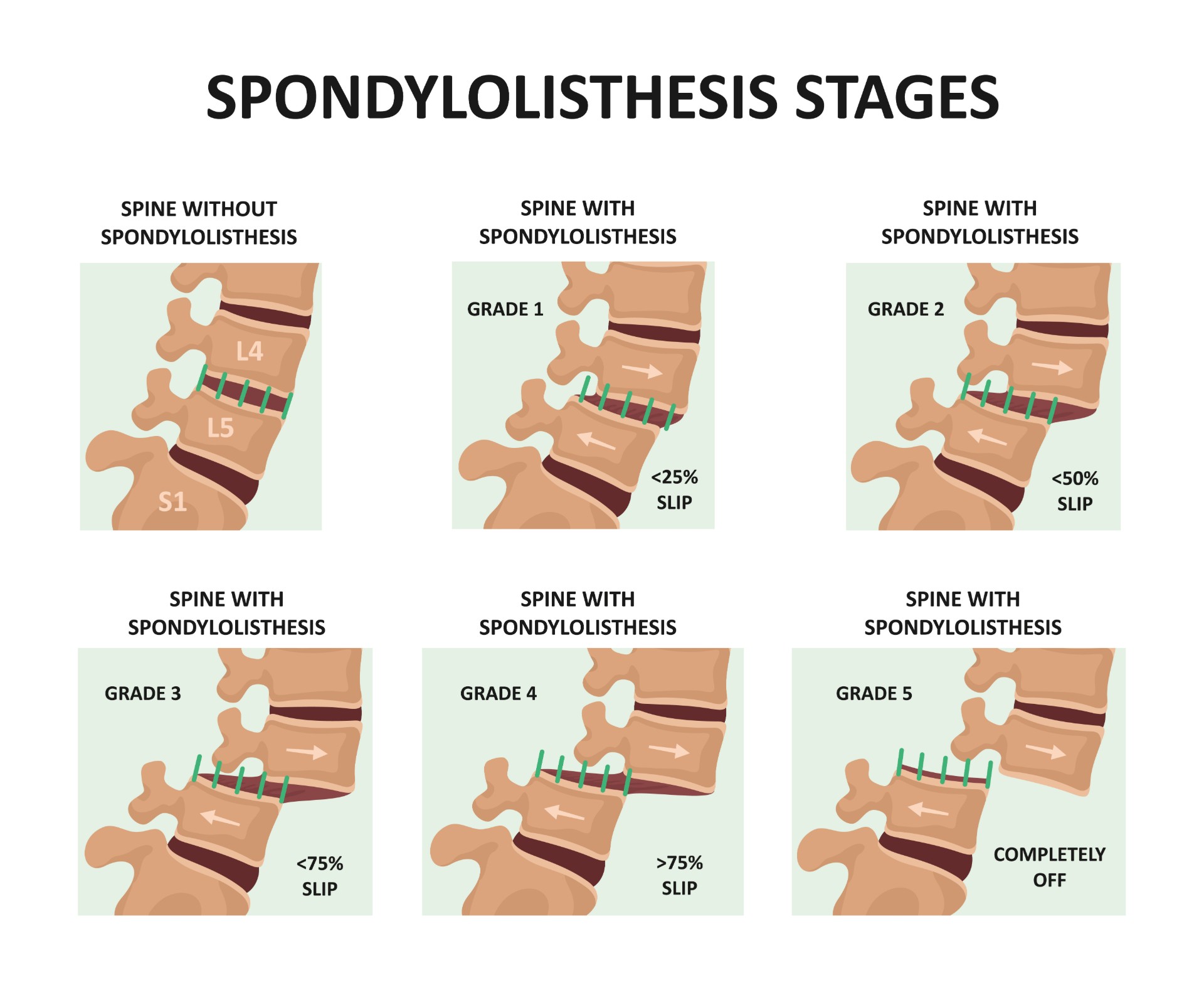 Spondylolisthesis Treatment In NJ Comprehensive Spine Care Spondylolisthesis Treatment In NJ Comprehensive Spine Care