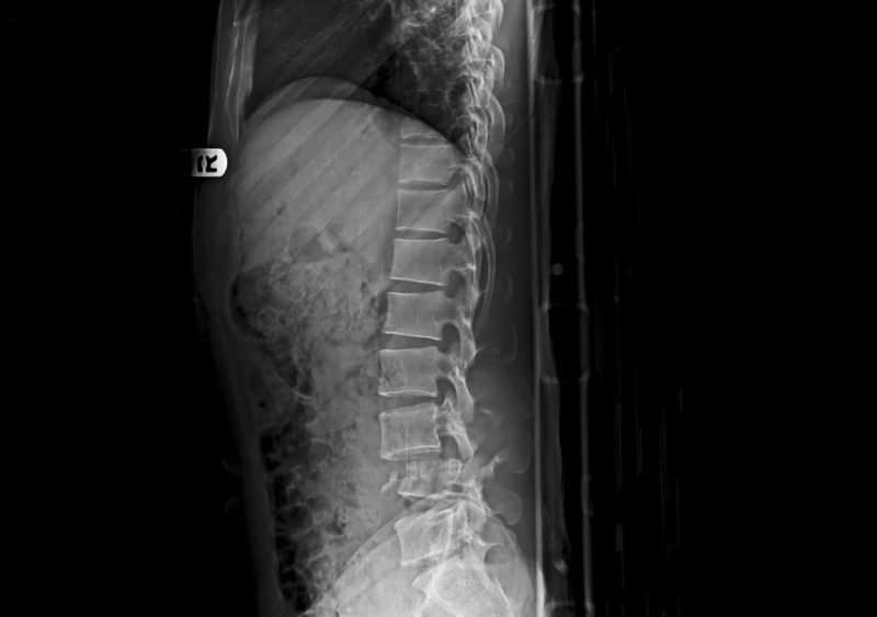 X-ray showing of Spine Fractures
