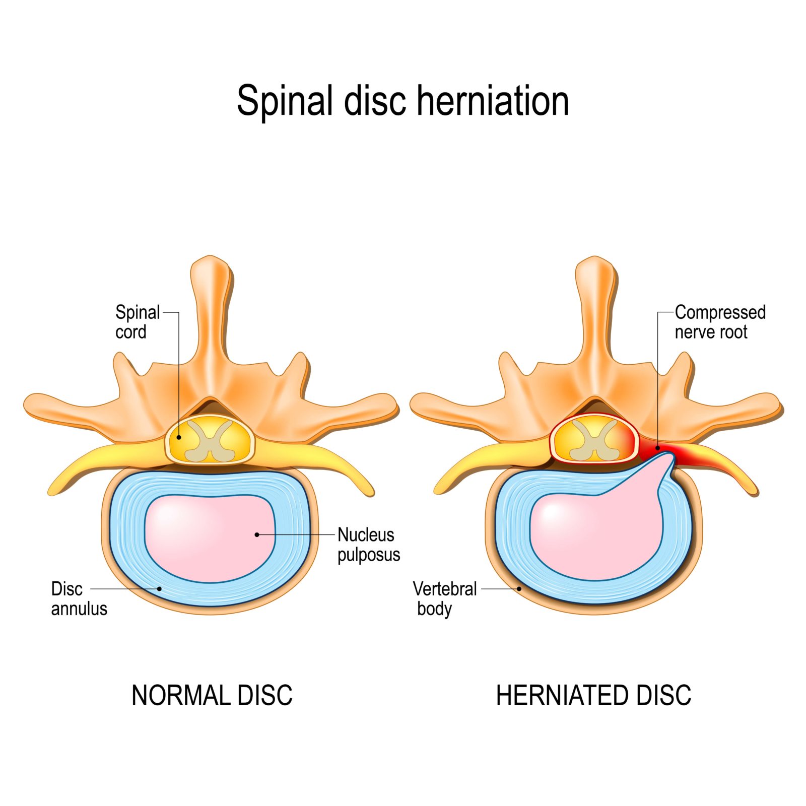 diagram of a normal disc and herniated disc