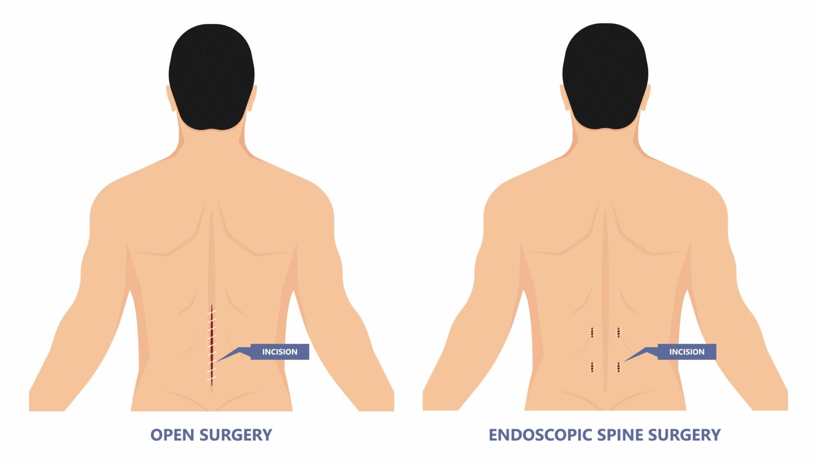 open vs. endoscopic surgery incisions