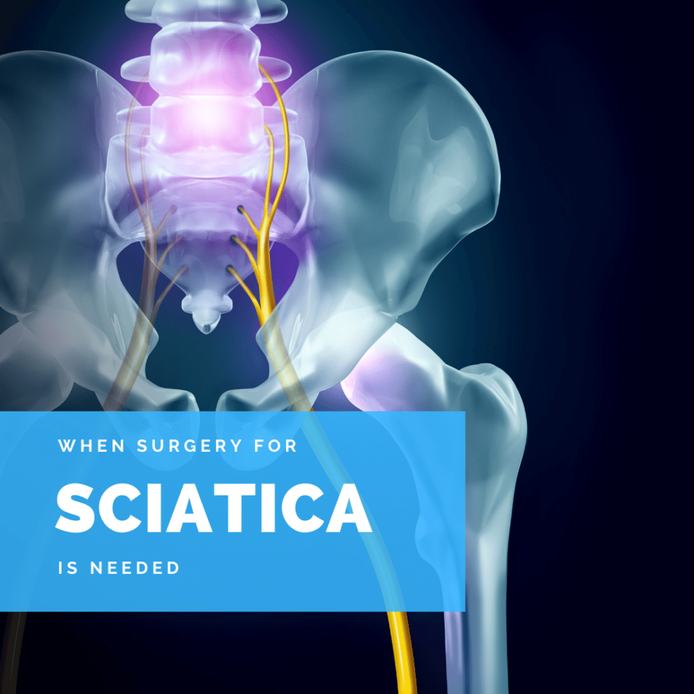 When Surgery Is Needed For Sciatica | New Jersey | Comprehensive Spine Care