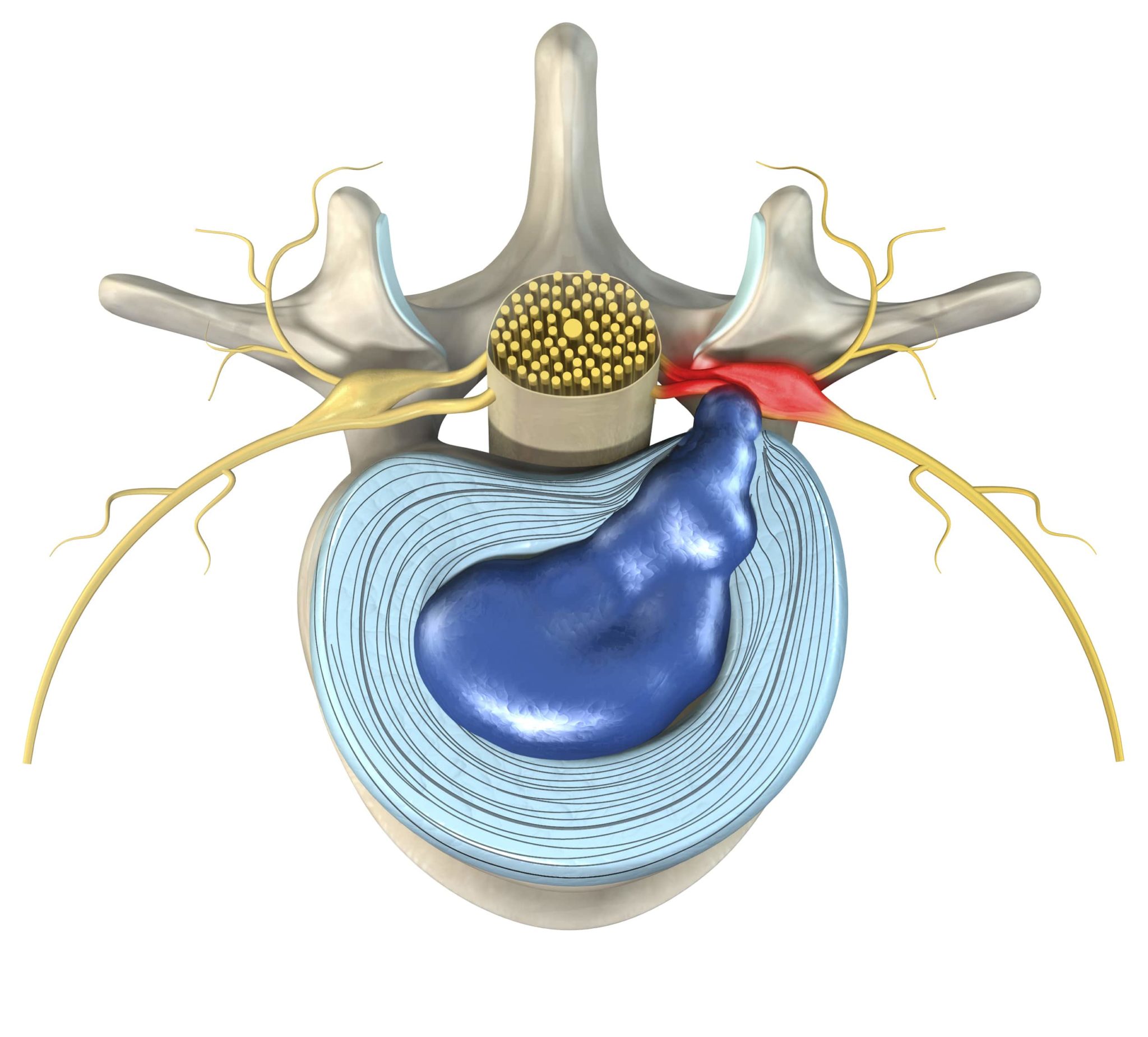 3 Signs Of A Slipped Disc | New Jersey | Comprehensive Spine Care