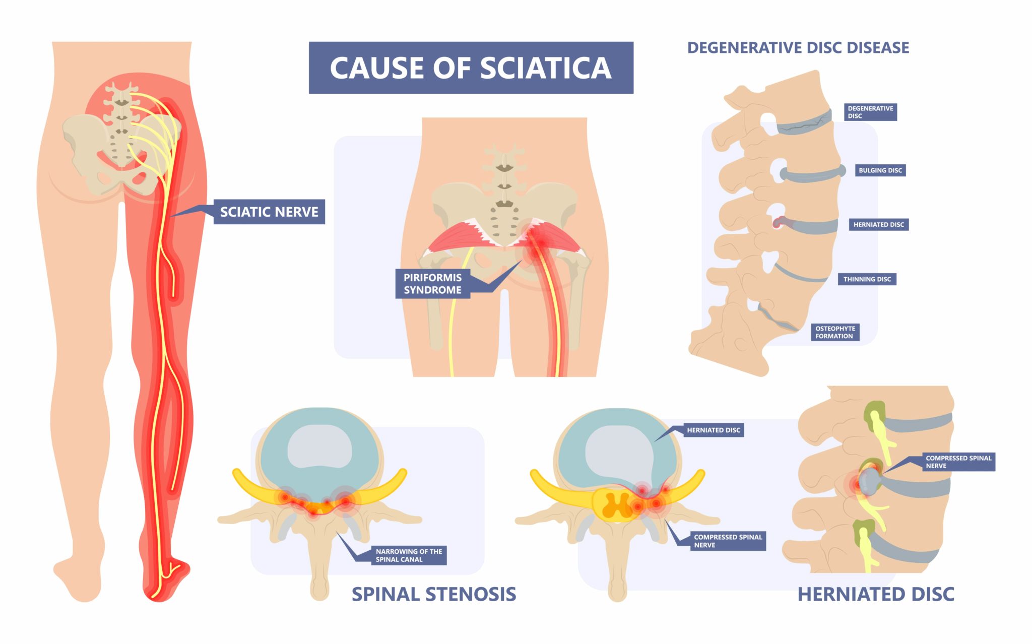 When Surgery Is Needed For Sciatica New Jersey Comprehensive Spine Care 8377