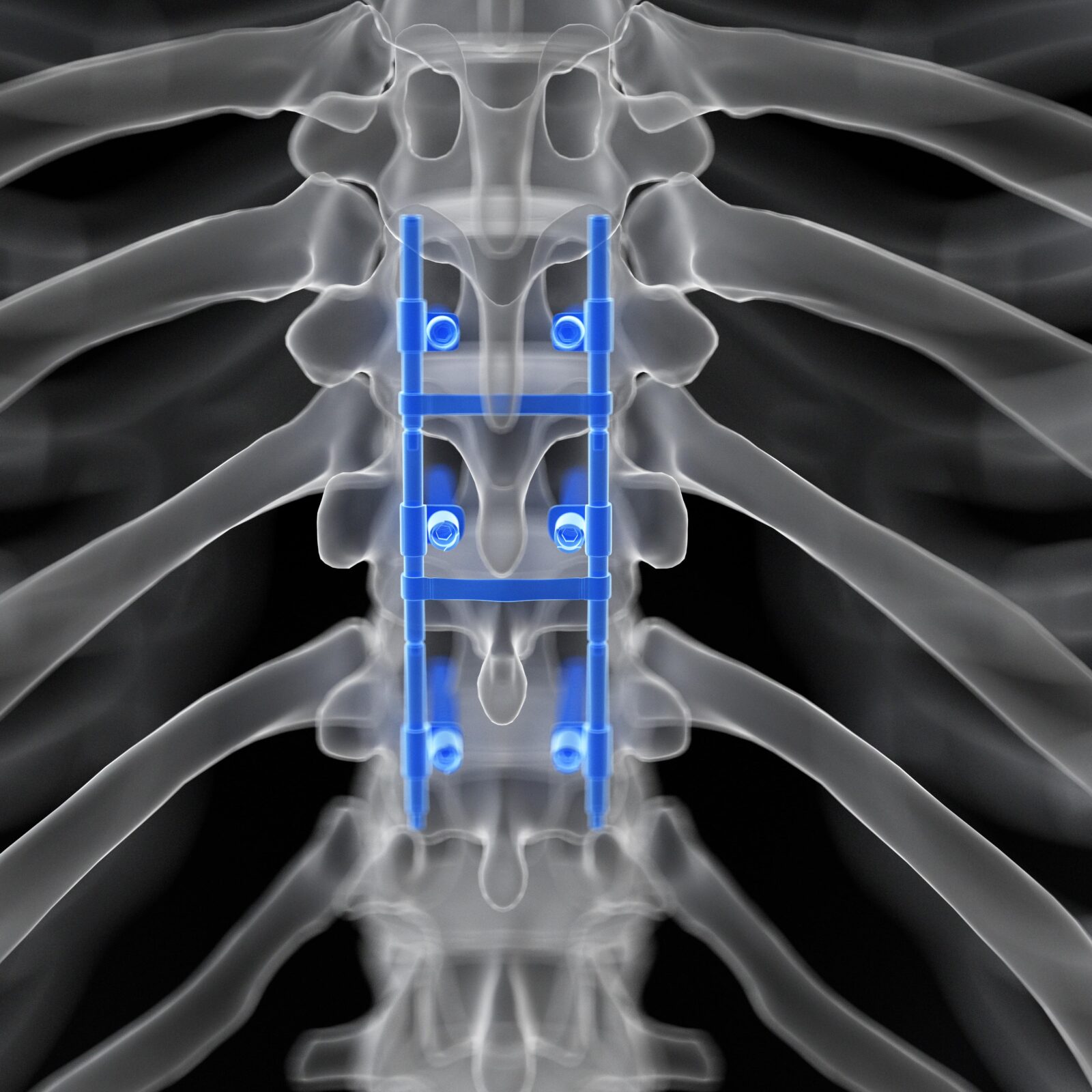spinal fusion with rods and screws