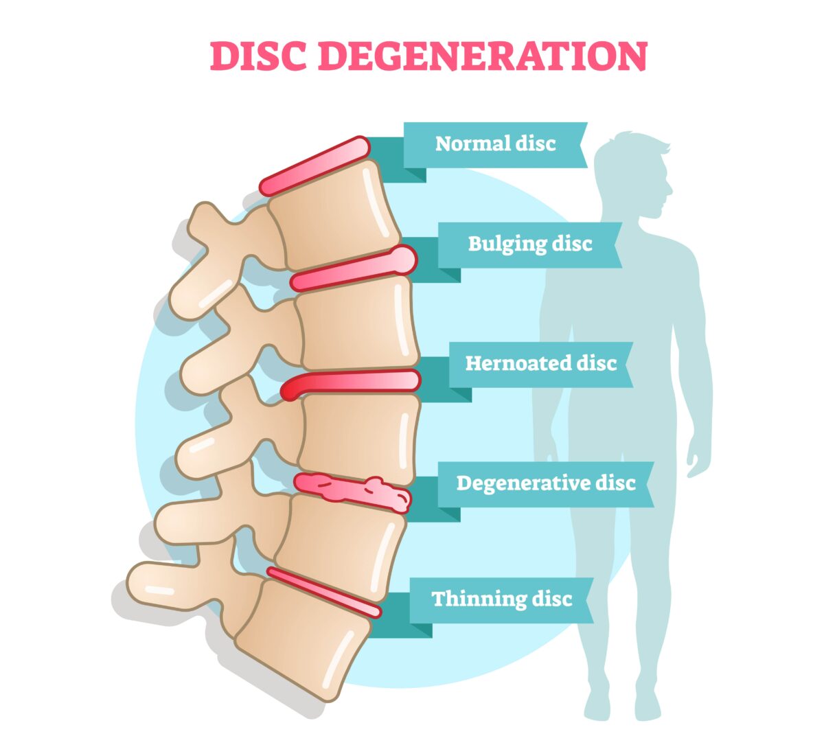 ipicture of bulging disc on spine