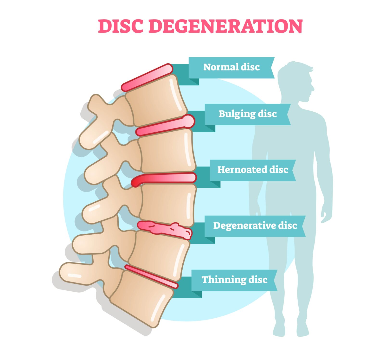 disc degeneration
