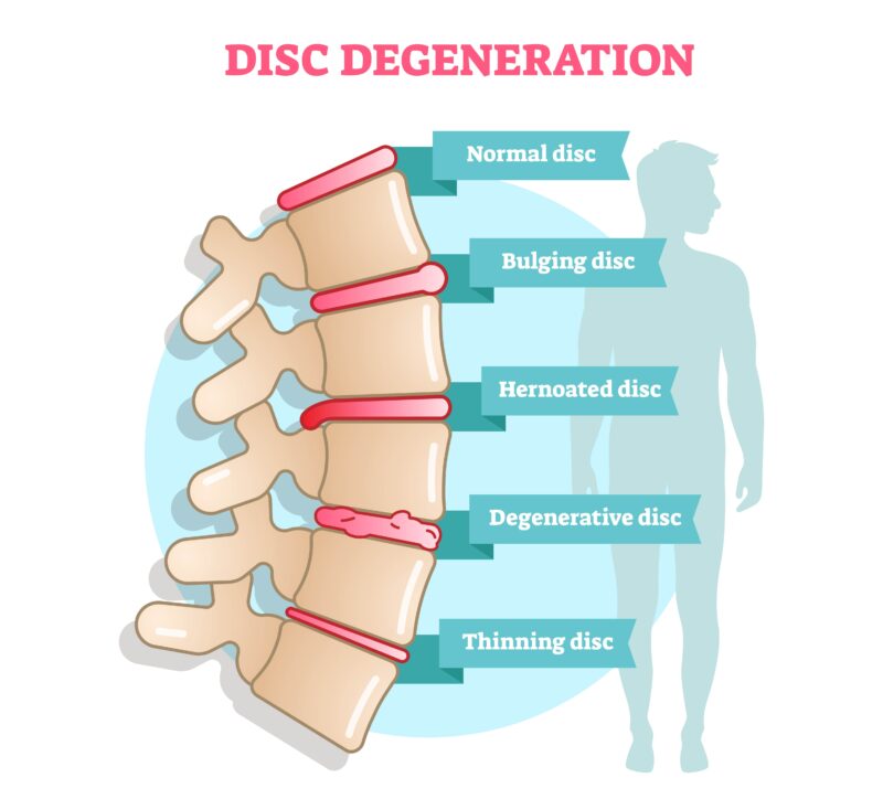 The Stages Of Degenerative Disc Disease New Jersey Comprehensive