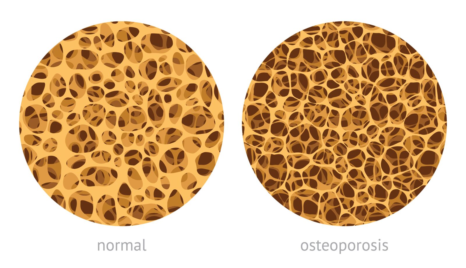 How Osteoporosis Affects The Spine New Jersey Comprehensive Spine Care