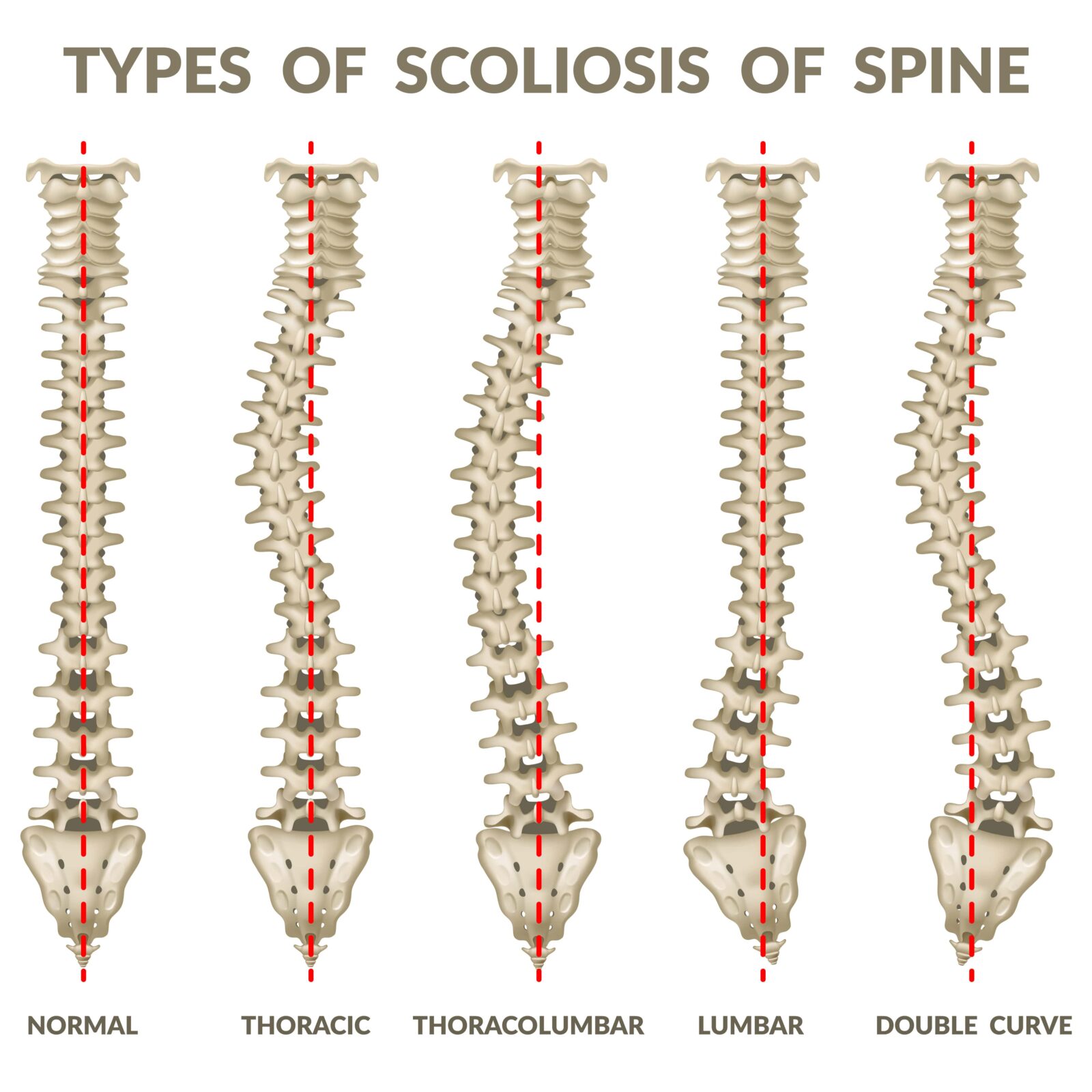 types of scoliosis curves
