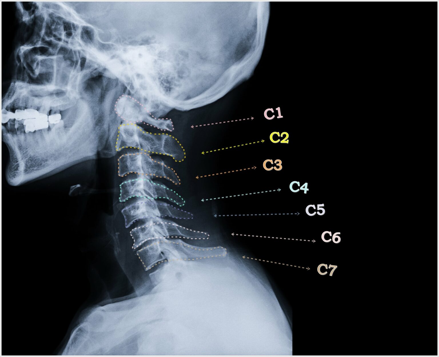 common-causes-of-chronic-neck-pain-new-jersey-comprehensive-spine-care