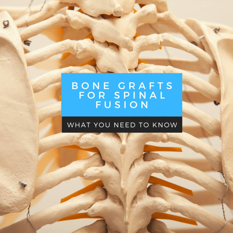 bone grafts for spinal fusion