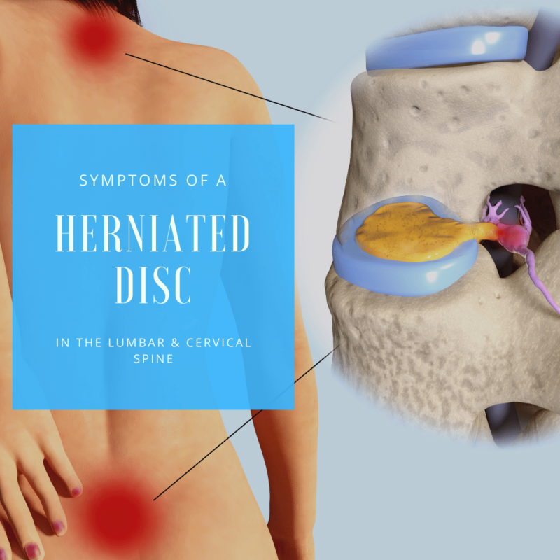 Symptoms of a herniated disc