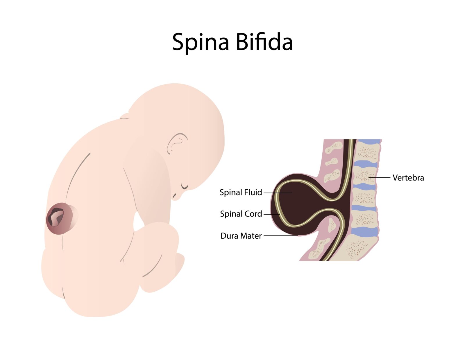 spina bifida 