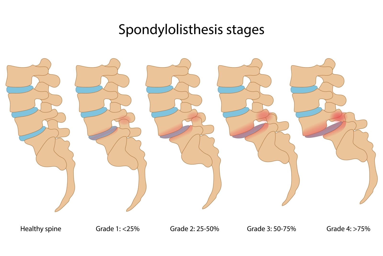 stages of spondylolisthesis