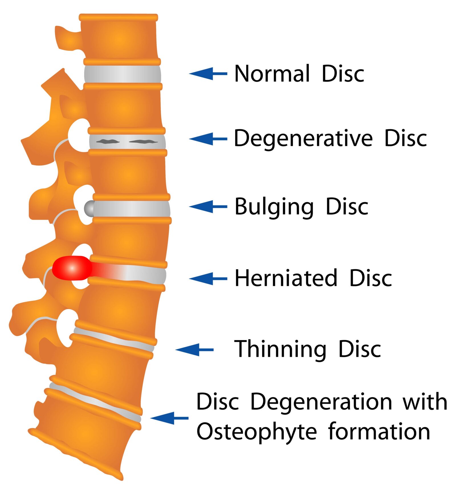assorted back problems shown on spine model
