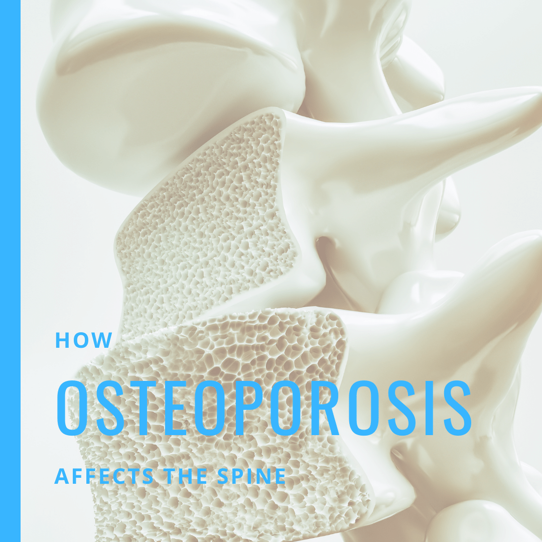 How Osteoporosis Affects the Spine