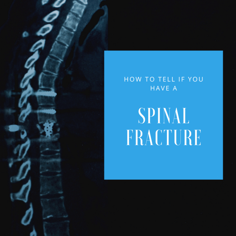 How To Tell If You Fractured Your Spine