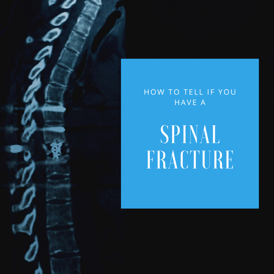How to Tell If You Have A Spinal Fracture