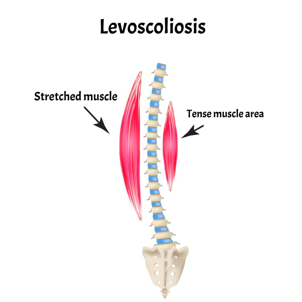 Levoscoliosis And Dextroscoliosis: How Are They Different? | New Jersey ...