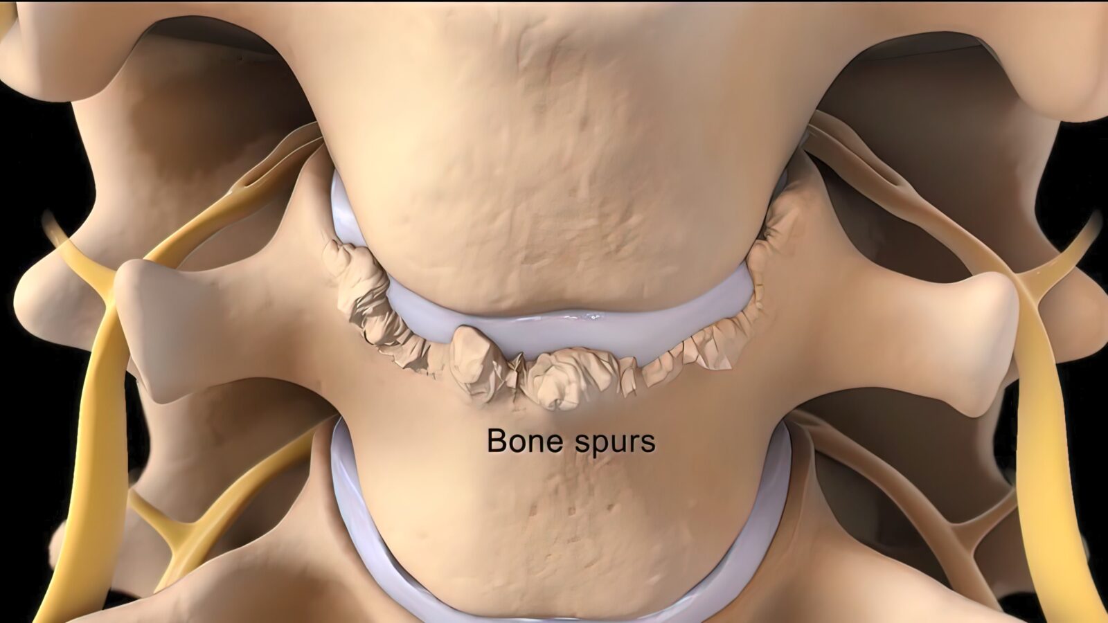 bone spurs on spine