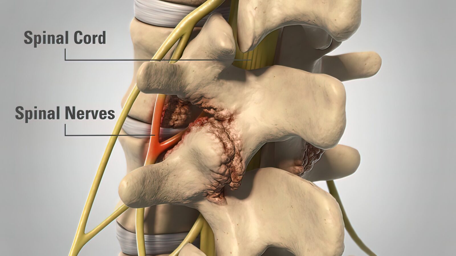 spinal degeneration and compressed nerves