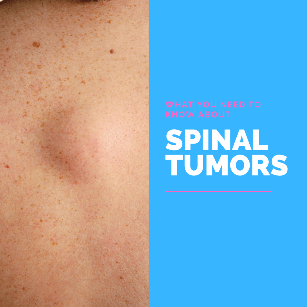 what-you-need-to-know-about-spinal-tumors-new-jersey-comprehensive