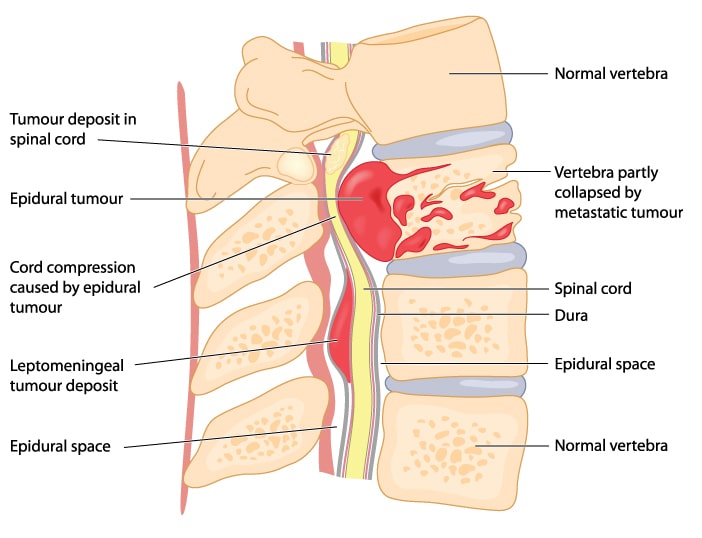 epidural spinal tumor