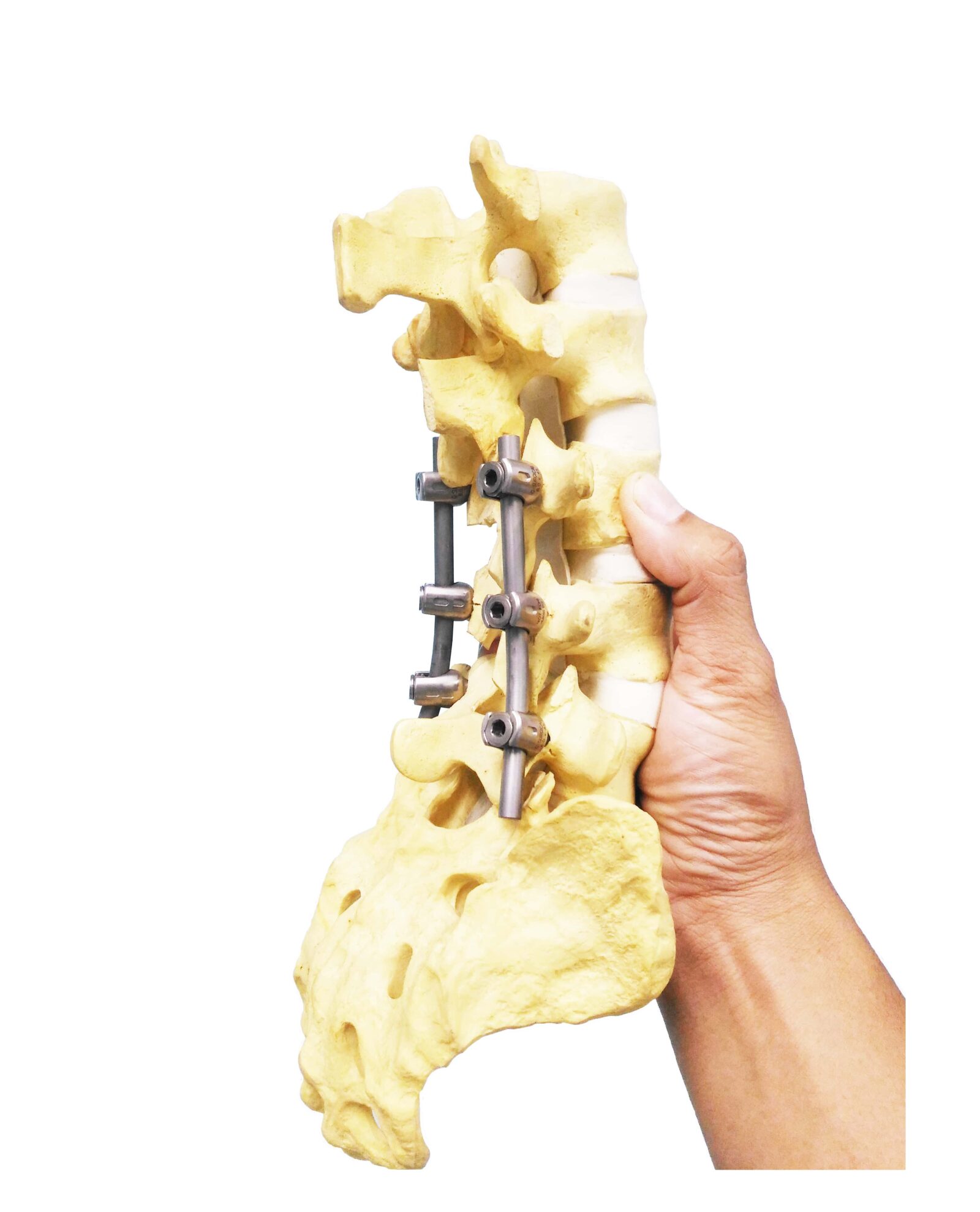 Close up Spinal model with fixation plate and screw in hand human. medical concept too bright image. on white background.
