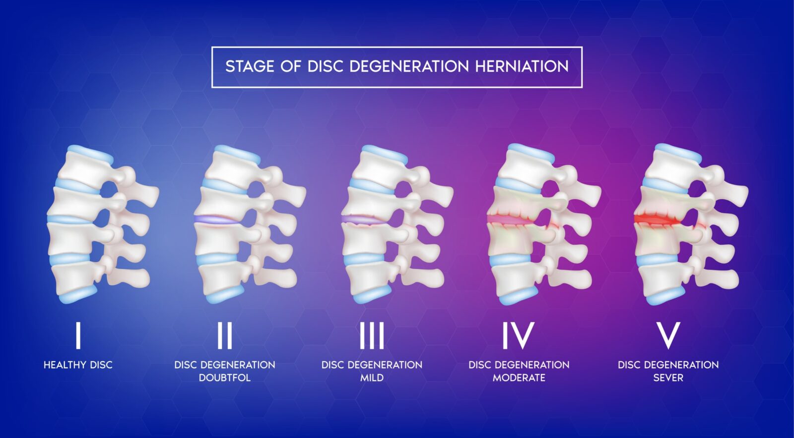 stages of disc degeneration
