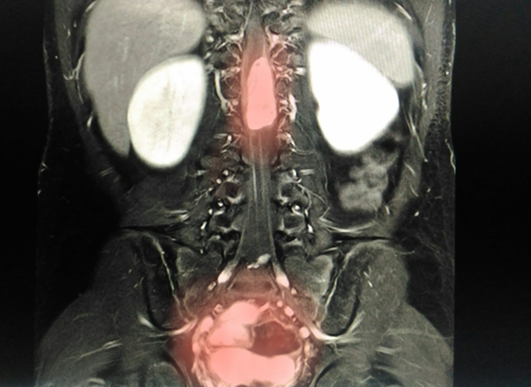 surgical-approaches-for-spinal-tumor-removal-minimally-invasive