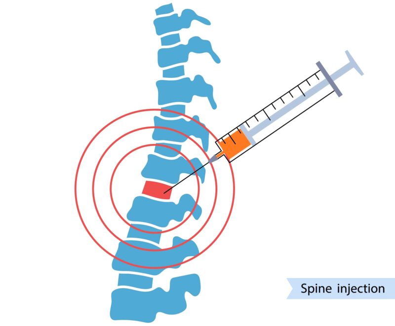 Spine joint injection. Pain and inflammation in the vertebra. Spinal arthritis disease concept. Medical research in spine center. Backbone treatment flat vector illustration for clinic or hospital.